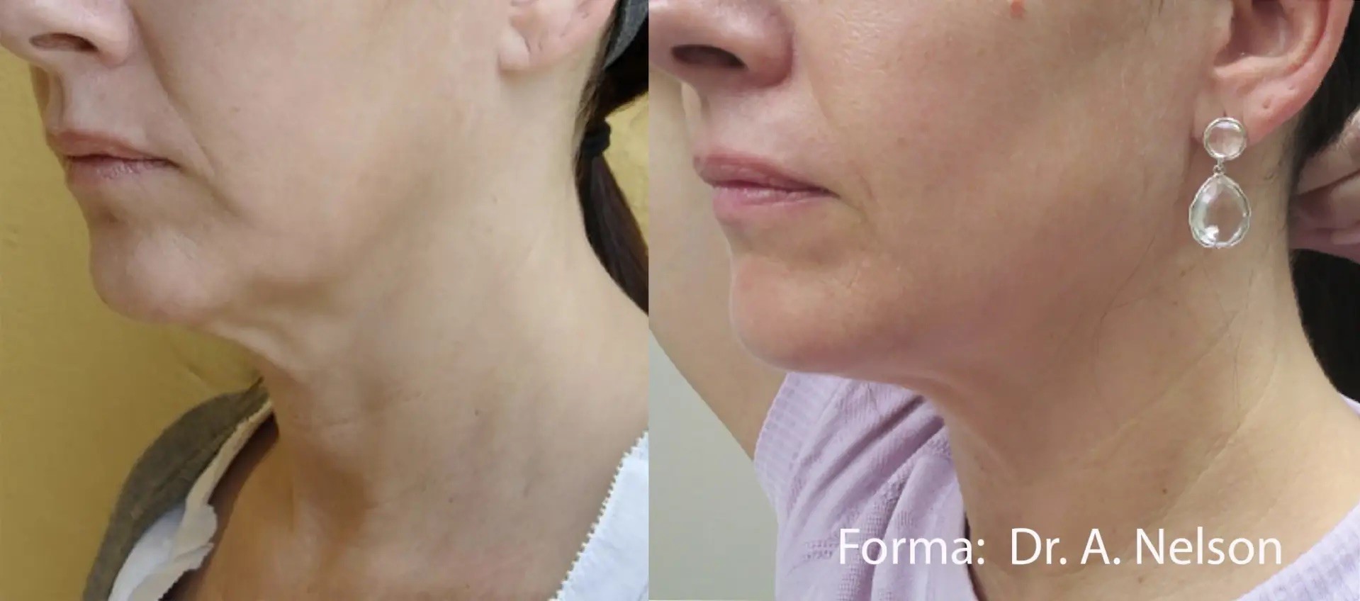 Forma treatment before and after