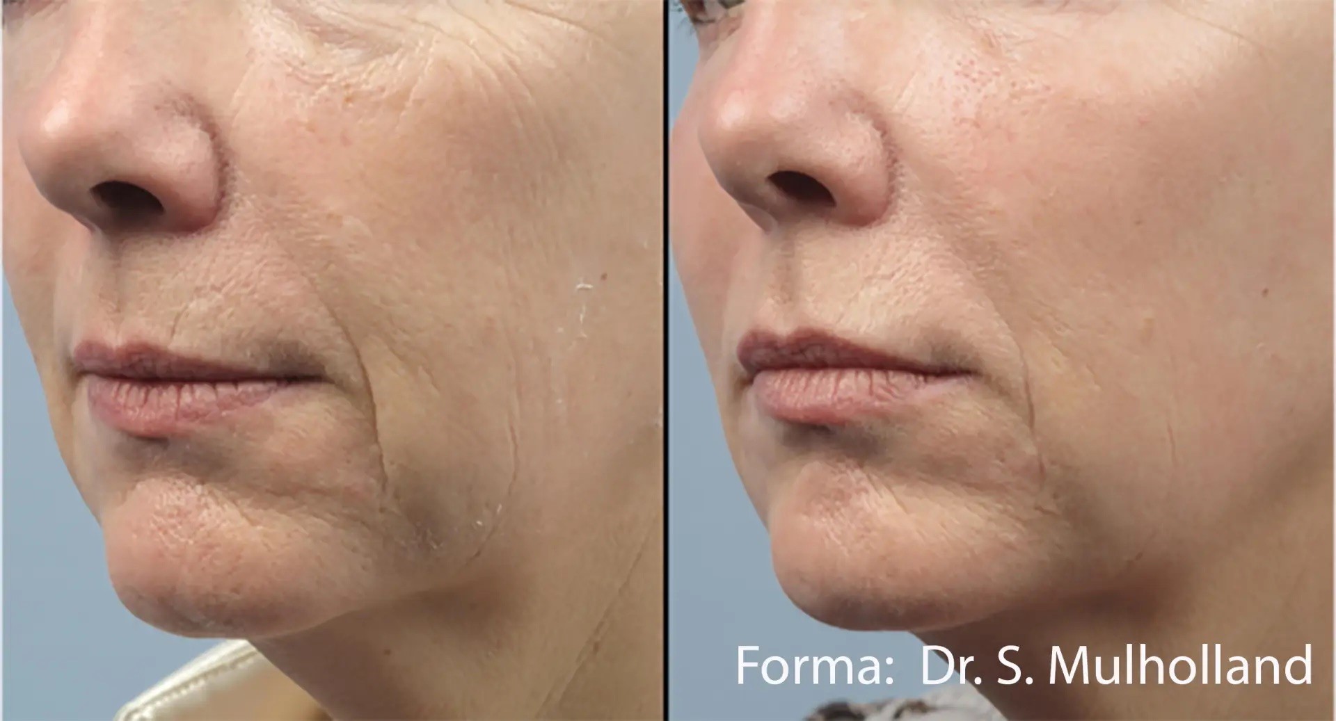 Forma treatment  before and after