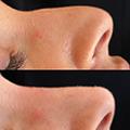 Rhinoplasty image