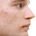 Acne & Roseacea Image